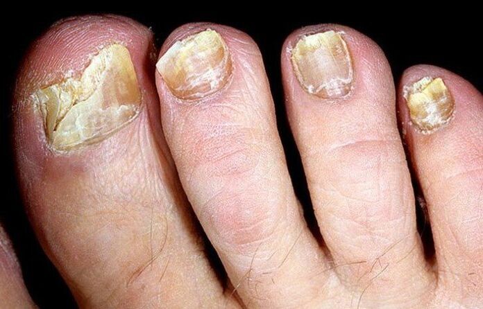 combaterea ciupercii unghiilor de la picioare cu oțet)